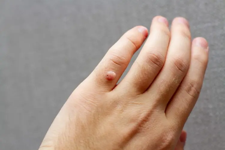 How to Get Rid of Your Warts
