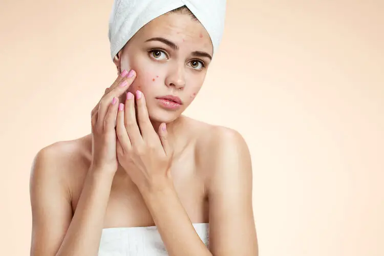 The Best Acne Treatments
